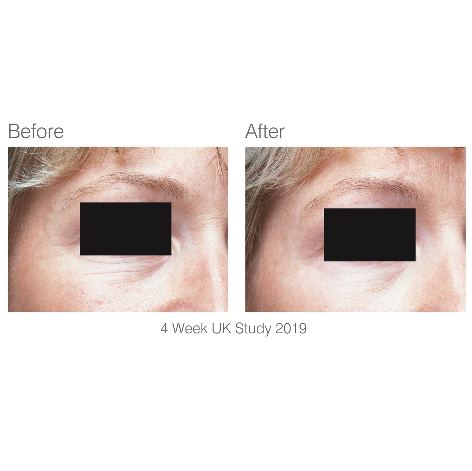 before and after 4 week study of eye area with visibly reduced wrinkles after using facelite beauty boosting LED face mask