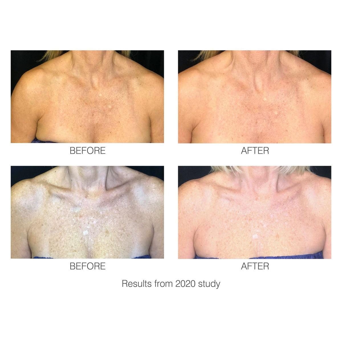 1/2 - 2020 Study - Before and after images showing how the decoLITE LED light treatment soft-fit mask has improved the look of wrinkles and pigmentation.